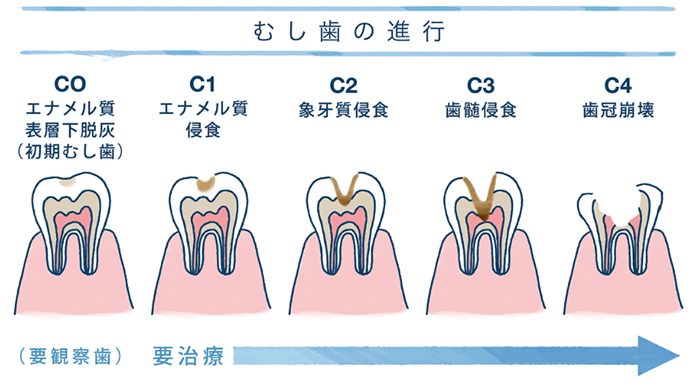 むし歯の進行を説明したイラスト