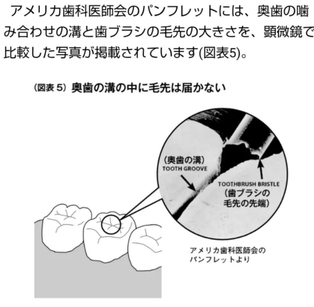 奥歯の溝に歯ブラシの毛先が届かないことを示すイラスト