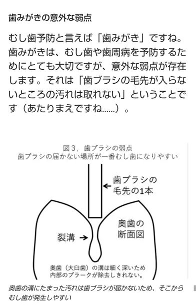 奥歯の断面図で、裂溝や深い溝にブラシが届かず、むし歯が発生しやすいことを示している